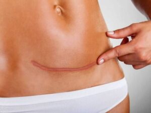 Read more about the article Terapia blizn: Skuteczność leczenia